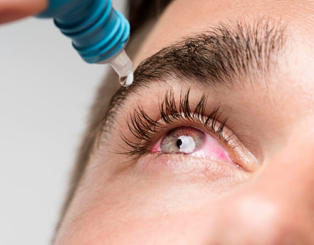 Preservatives and Preservative-Free Eye Drops for Dry Eye