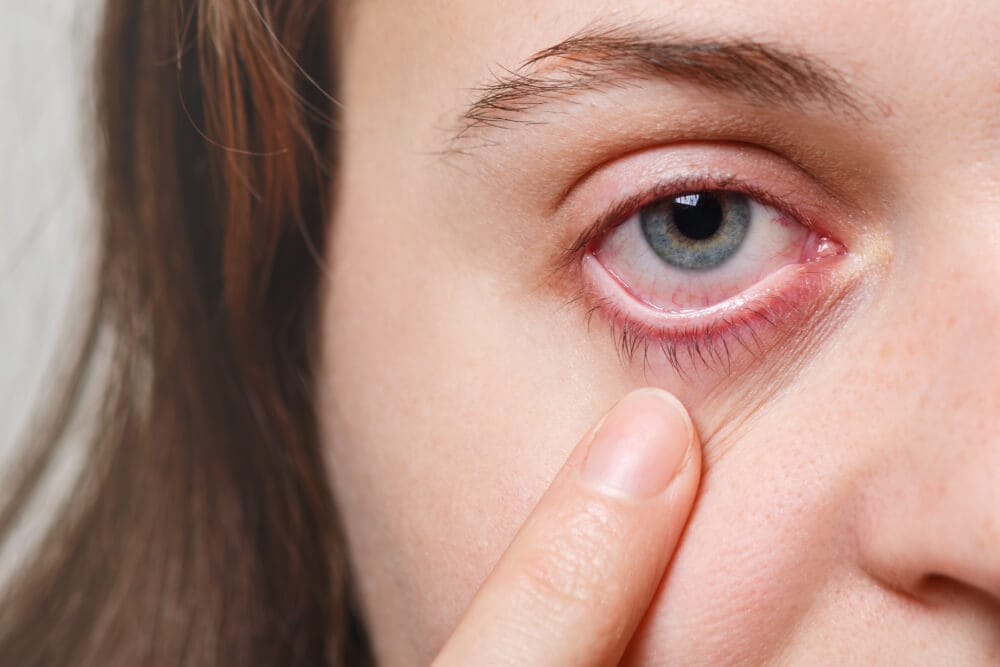 Symptoms of pink eye