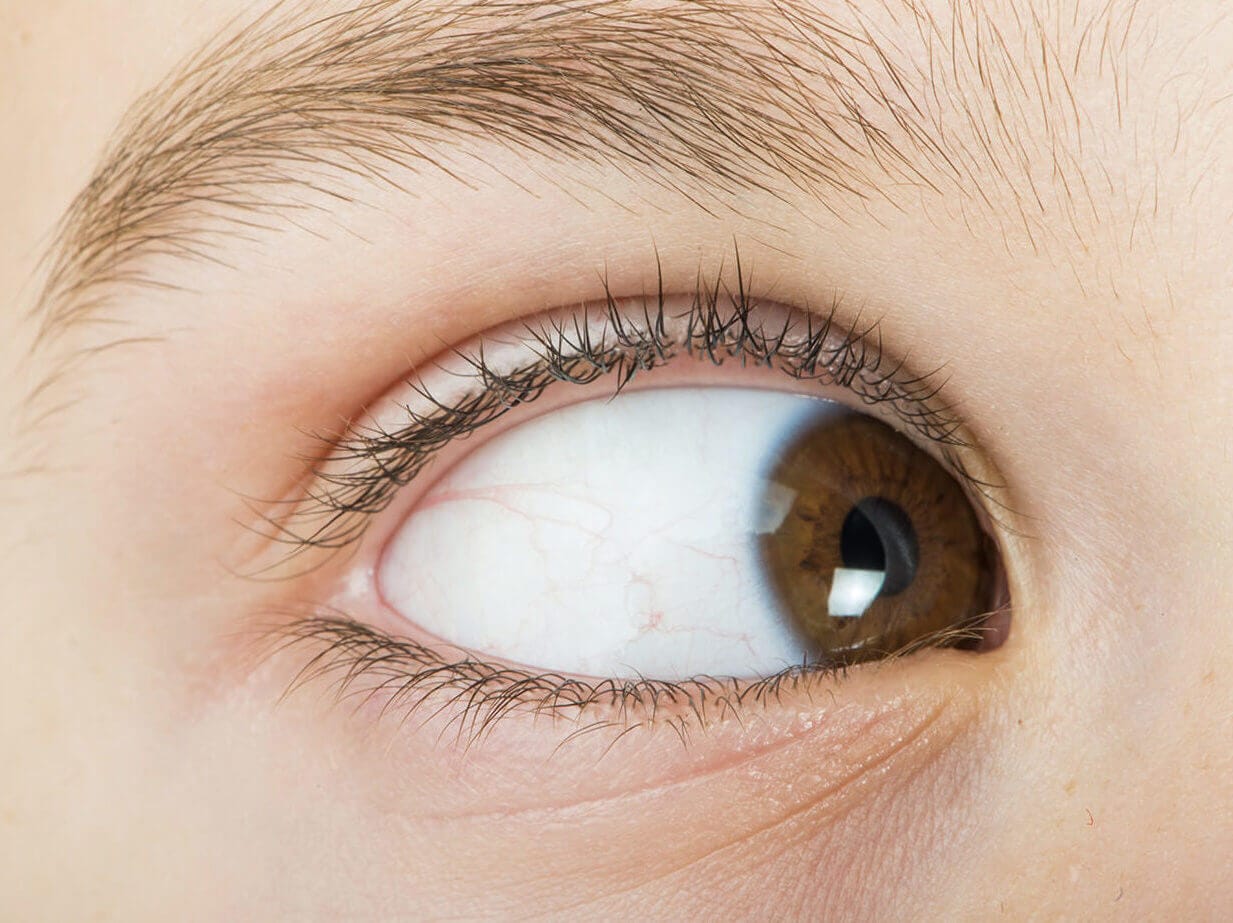 Misdiagnosed Lazy Eye Optometrist