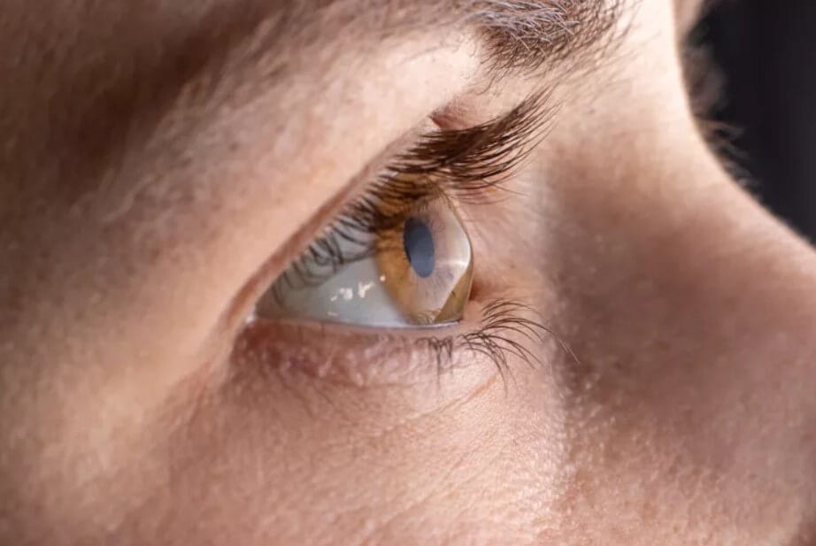 Is There a Cure for Keratoconus? Optometrist