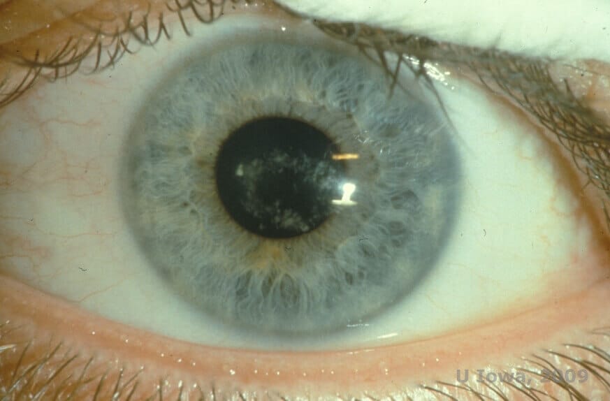 Scleral Lenses: Advanced Treatment for Lattice Corneal Dystrophy Optometrist