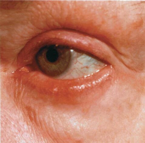 Example of the progression of a typical eye infection