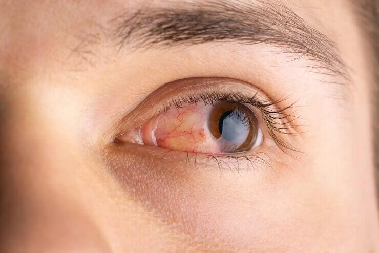 How to Administer Brimonidine Eye Drops