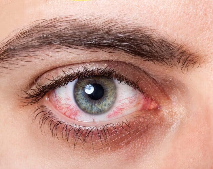 What is pink eye?