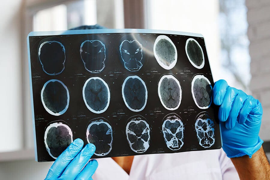 What Vision Issues Can Traumatic Brain Injuries Cause?