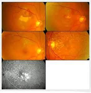 Understanding the Root Causes of Retinal Vein Occlusion or Eye Stroke