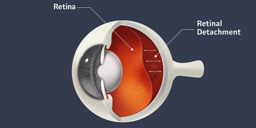 How Long Before Retinal Detachment Causes Blindness? Optometrist